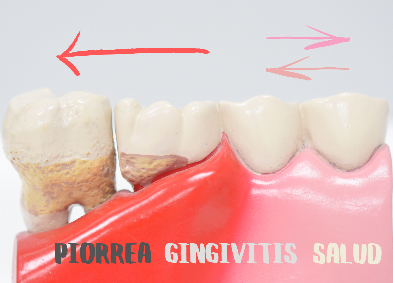 Tratamiento de las encías y Periodoncia Tratamiento de las encías
